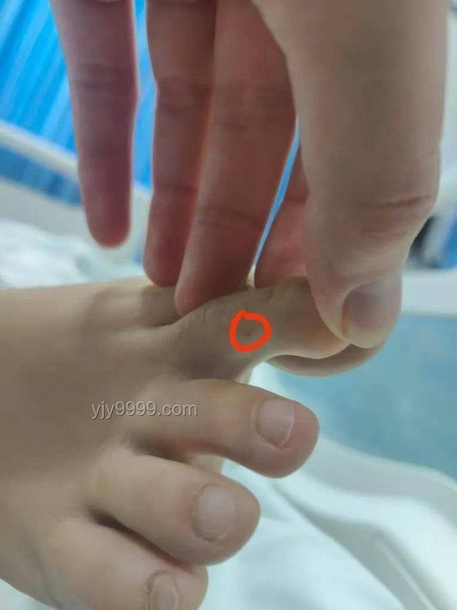 三亚被咬女子神经毒蛇咬伤案例研究